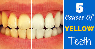 The causes and the cures of yellow teeth you should know