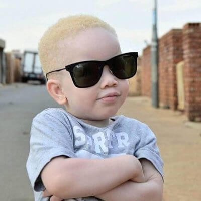 Malawi police hunts for thug attempting to kidnap albino boy