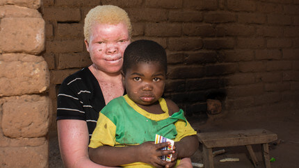 Malawian man behind bars for plotting to abduct girl with albinism