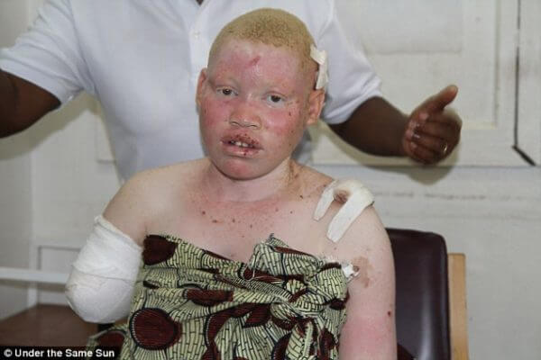 Malawi: Killing of man with albinism underscores past policing and criminal justice failures