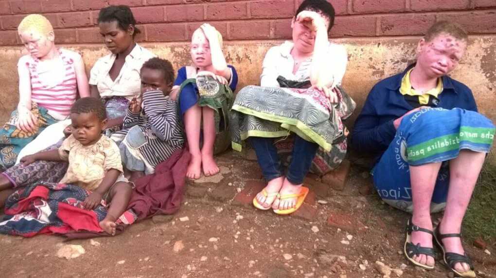 Herbalists vow to fight albino slaughtering