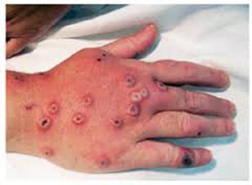 Rabies outbreak kills two children in Chitipa; take cover