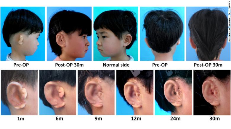 China scientists grow new ears for children with defect