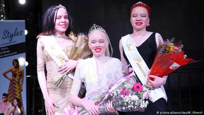 Zimbabwe Crowns Miss Albino in Bid to End Stigma