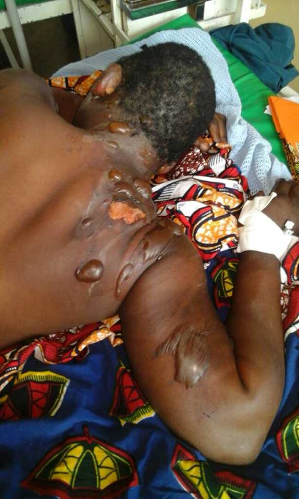 Balaka Woman scalded with porridge for tempting to rescue her sister from abusive husband