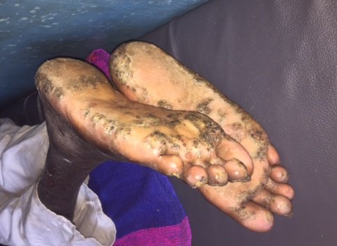 Jigger flea hits Malawi’s Mulanje