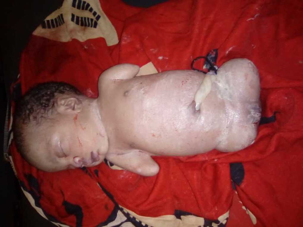 Bizzare: Kasungu baby girl born without arms, legs
