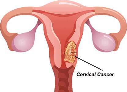 Malawi Govt asked to swiftly implement intellectual property laws for affordable cervical cancer treatment
