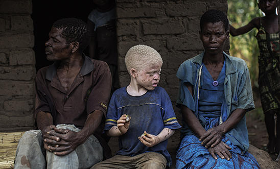 The ritual murders of people with albinism in Malawi