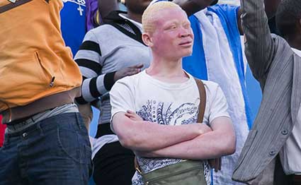 Albino Protest