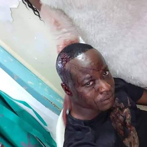 Unknown thugs severely beat former Malawi Catholic University student Flora Ciliphily for being lesbian 