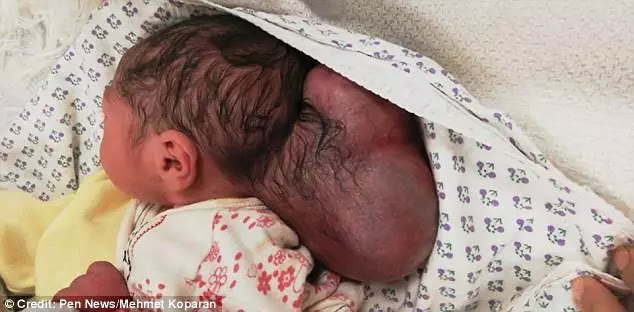 Shocking!!! Syrian baby born with part of his BRAIN protruding from his head