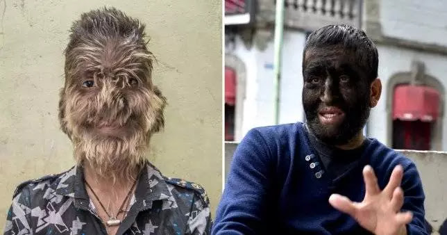 Shocking!Children in Spain develop ‘werewolf syndrome’ after taking contaminated medicine
