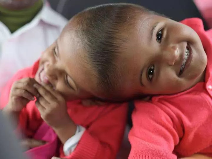 Whee!!! Conjoined Bangladeshi twins separated after 33-hour surgery
