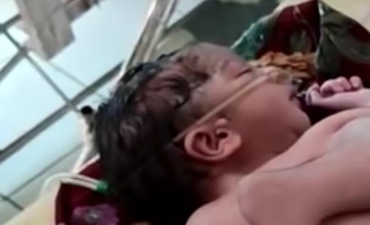 Bizarre!Indian woman gives birth to baby with four legs and three hands
