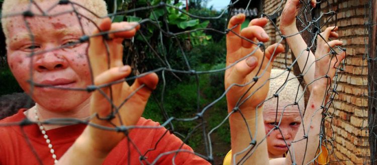 Criminals frustrate protection of albinos in Malawi