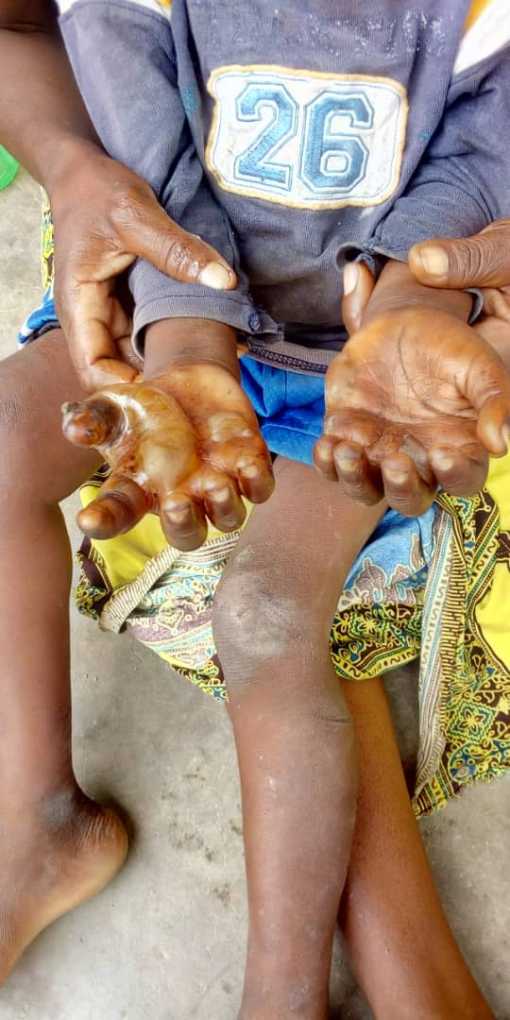 Malawian father burns stepson’s hands over relish
