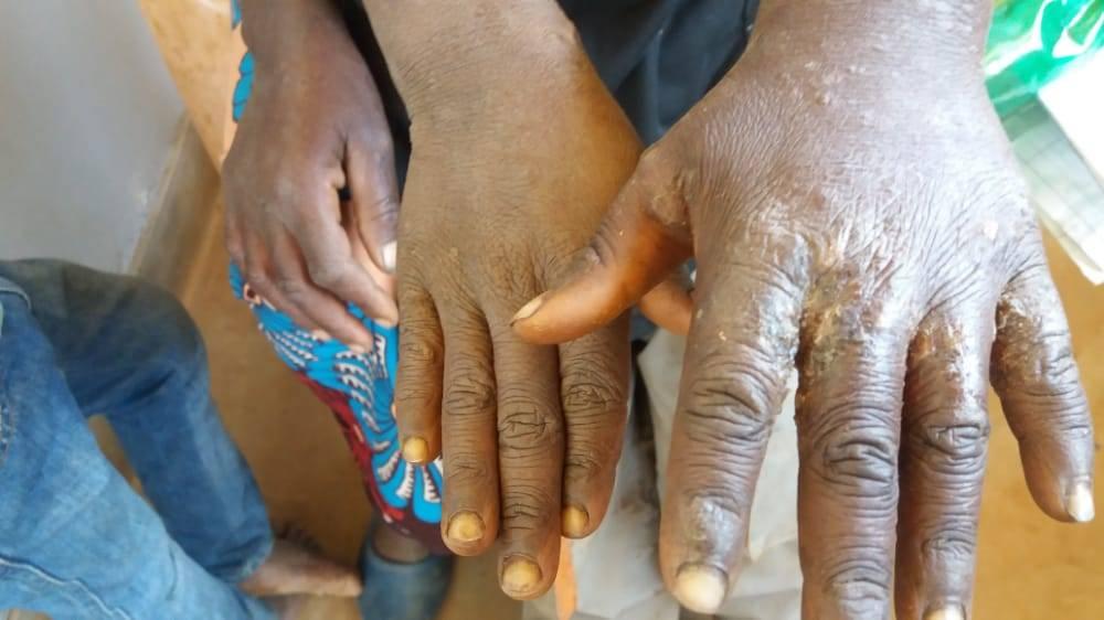 Scabies hit hard Malawi’s Dedza district