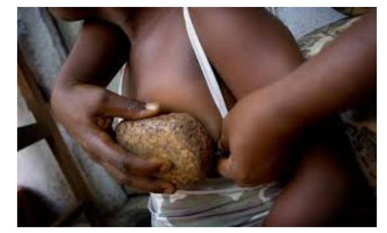 Weird! Cameroonian mothers iron their daughters breasts to reduce attraction