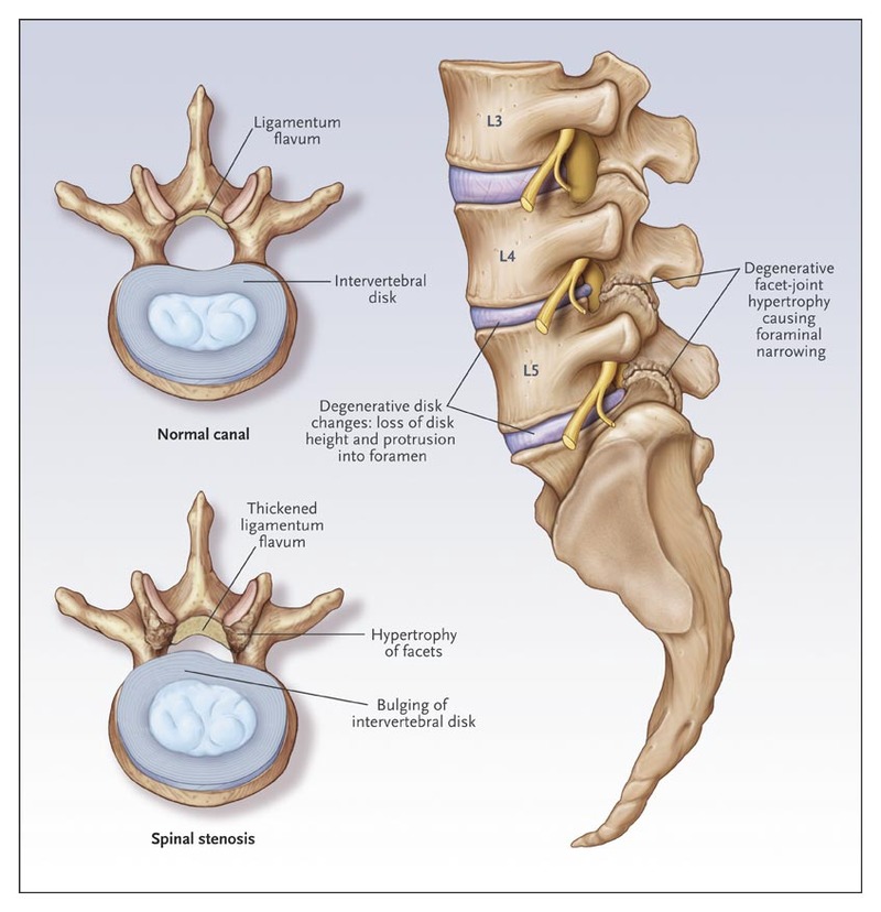 Methods of Treatment of Lumbar Spinal Stenosis
