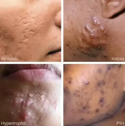 How Syphilis can live in ones’ body for 20 years without knowing