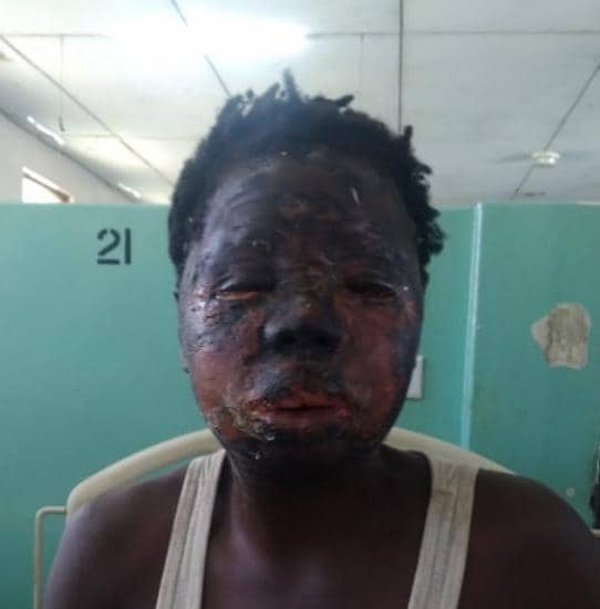 Mangochi man Missi Bwanali jail for pouring wife hot water