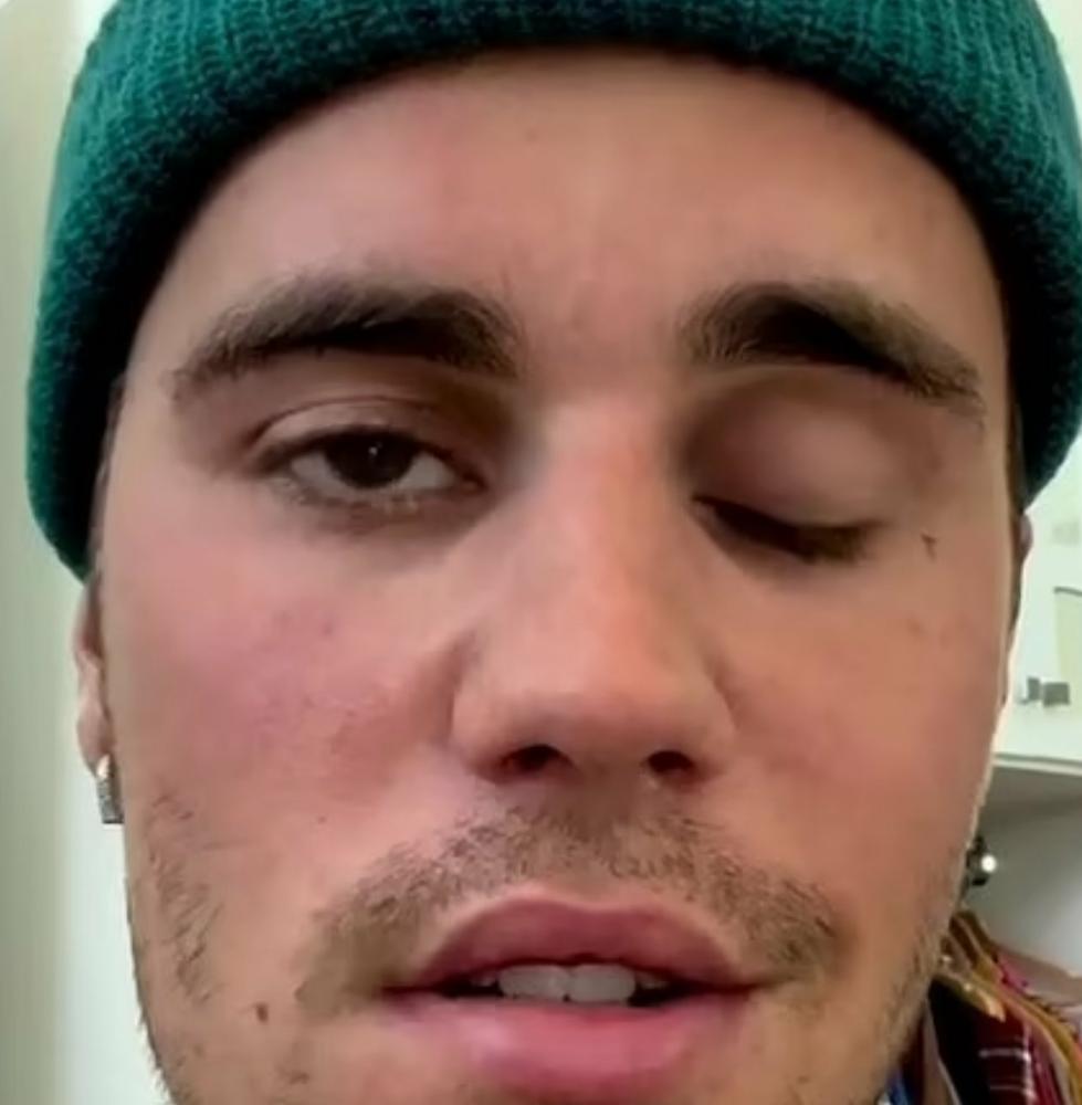 Canadian singer Justin Bieber suffers face paralysis