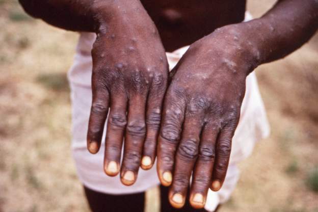 WHO to rename Monkeypox to remove African stigma