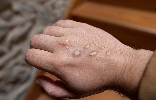 Italian man becomes first person to test positive for HIV, Monkeypox, COVID-19 at once