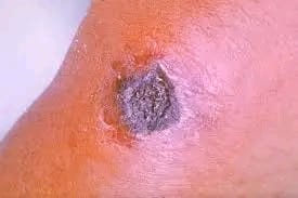 Malawi on Zambia’s anthrax outbreak alert