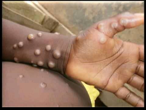 Ministry warns higher education institutions over Mpox