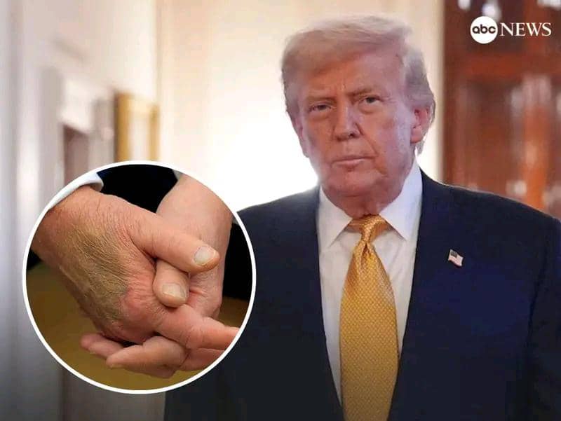 Trump diagnosed with chronic venous insufficiency after medical testing