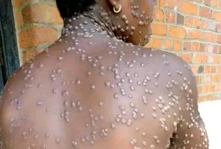 Malawi records 90 Mpox cases since April