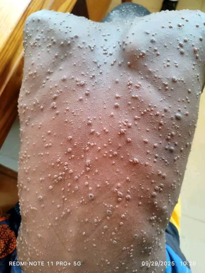 Machinga District Hospital reports second suspected Mpox case