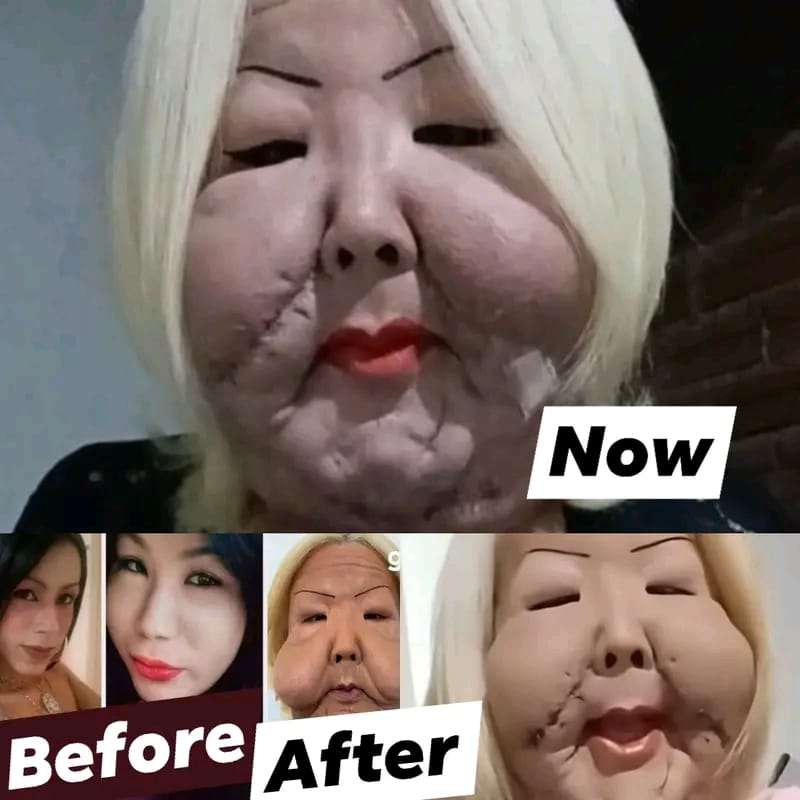 Brazilian influencer Juliana Oliveira’ face disfigured by botched procedure: Fights to rebuild her face